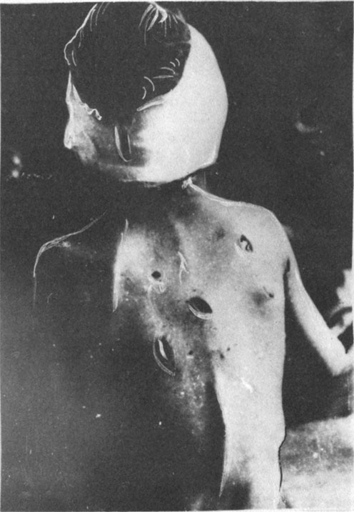Сербская девочка с несколькими колотыми ранами, которые ей нанесли усташи в голову и спину. Помещена на лечение в больницу в Оброваце (Архив МИД Италии)