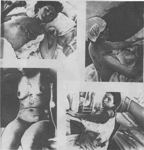 Сербки православной веры из Дивосела, раненные усташами и находящиеся на излечении в лагерной больнице в Оточаце (Архив МИД Италии)